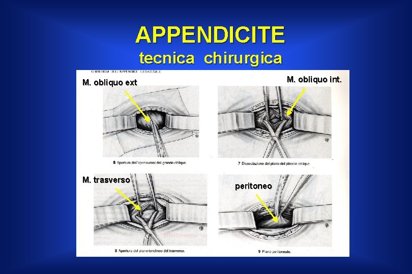 APPENDICITE tecnica chirurgica M. obliquo int. M. obliquo ext M. trasverso peritoneo 