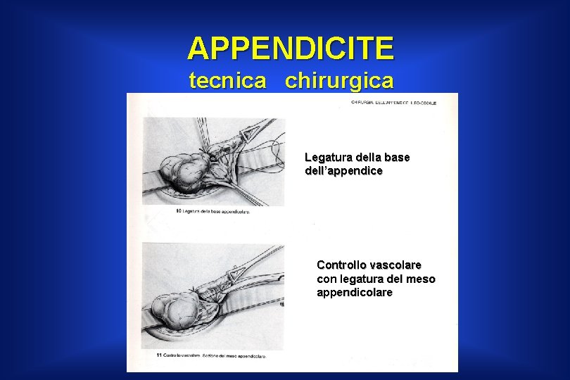 APPENDICITE tecnica chirurgica Legatura della base dell’appendice Controllo vascolare con legatura del meso appendicolare