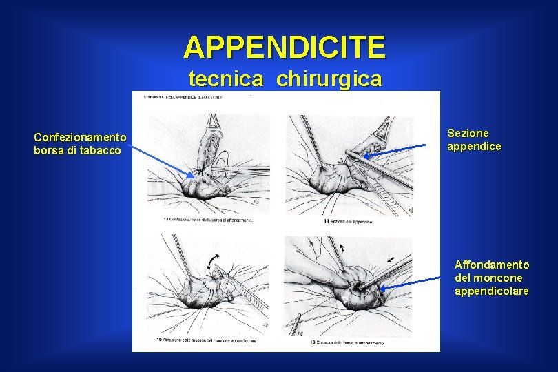 APPENDICITE tecnica chirurgica Confezionamento borsa di tabacco Sezione appendice Affondamento del moncone appendicolare 