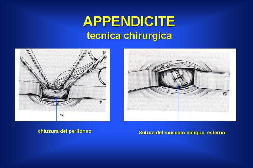 APPENDICITE tecnica chirurgica chiusura del peritoneo Sutura del muscolo obliquo esterno 