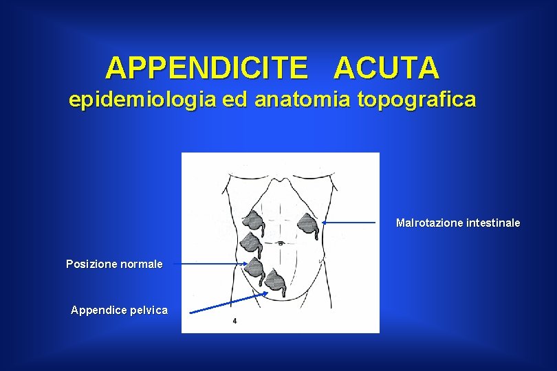 APPENDICITE ACUTA epidemiologia ed anatomia topografica Malrotazione intestinale Posizione normale Appendice pelvica 