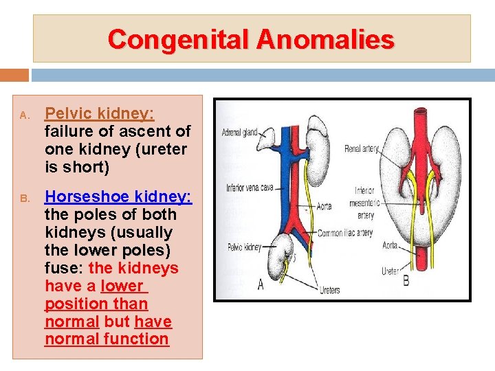 Congenital Anomalies A. B. Pelvic kidney: failure of ascent of one kidney (ureter is