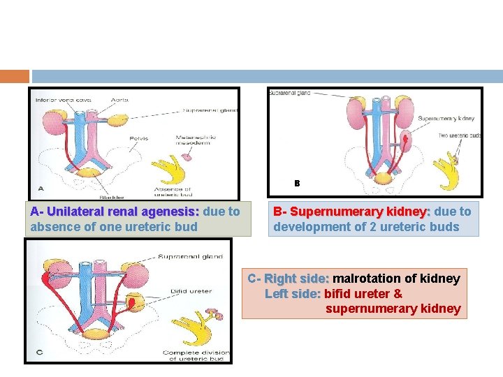 B A- Unilateral renal agenesis: due to absence of one ureteric bud B- Supernumerary