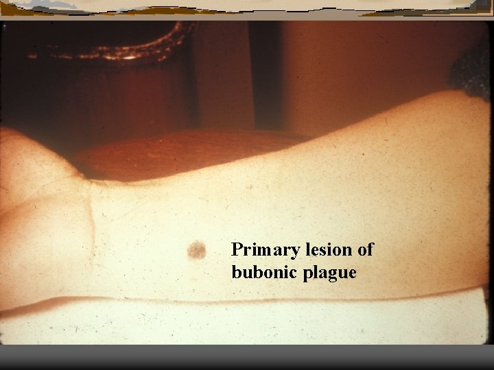 Primary lesion of bubonic plague 