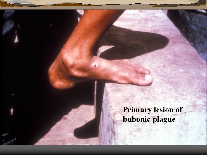 Primary lesion of bubonic plague 