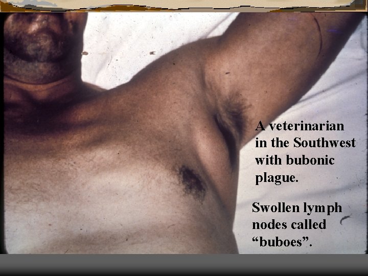 A veterinarian in the Southwest with bubonic plague. Swollen lymph nodes called “buboes”. 