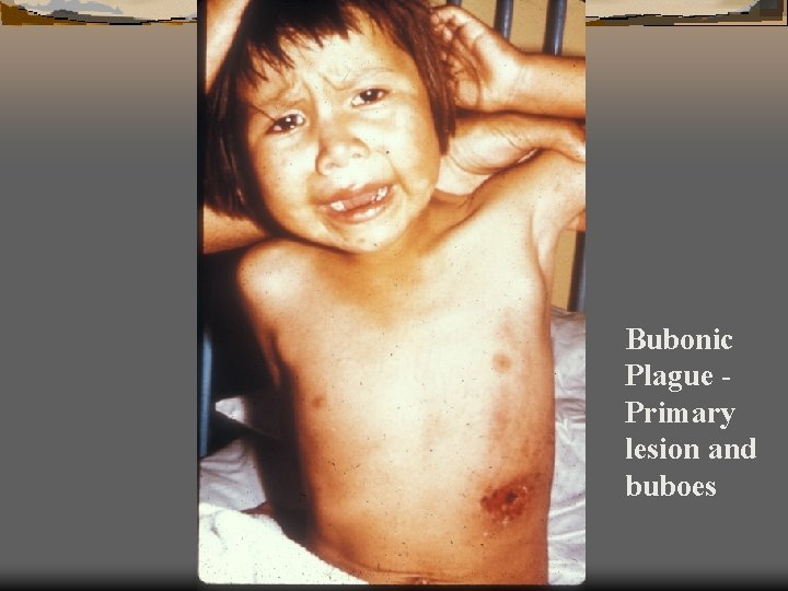 Bubonic Plague Primary lesion and buboes 