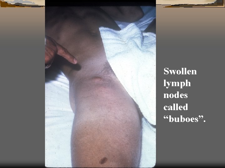 Swollen lymph nodes called “buboes”. 