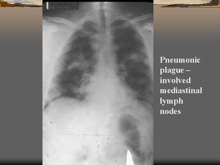 Pneumonic plague – involved mediastinal lymph nodes 