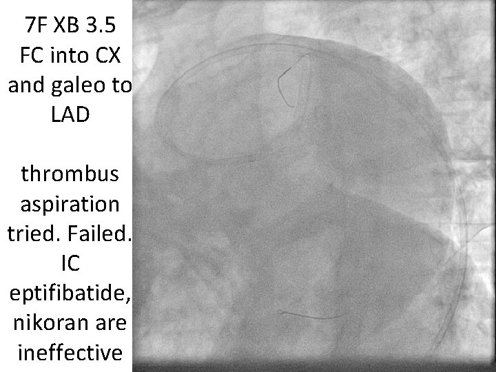 7 F XB 3. 5 FC into CX and galeo to LAD thrombus aspiration