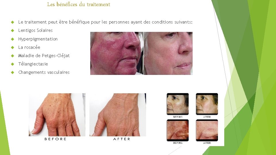Les bénéfices du traitement Le traitement peut être bénéfique pour les personnes ayant des Les bénéfices du traitement Le traitement peut être bénéfique pour les personnes ayant des