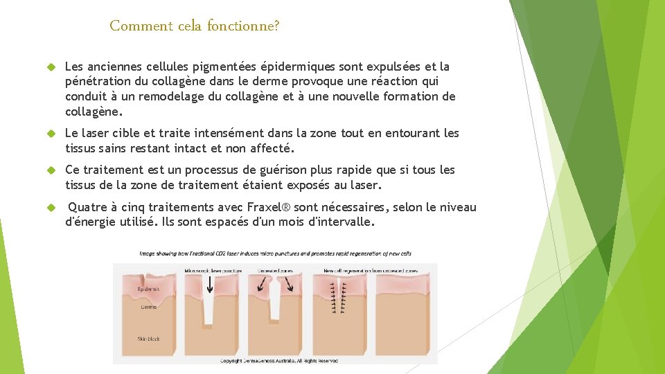 Comment cela fonctionne? Les anciennes cellules pigmentées épidermiques sont expulsées et la pénétration du Comment cela fonctionne? Les anciennes cellules pigmentées épidermiques sont expulsées et la pénétration du