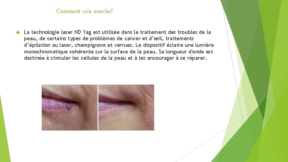 Comment cela marche? La technologie laser ND Yag est utilisée dans le traitement des Comment cela marche? La technologie laser ND Yag est utilisée dans le traitement des