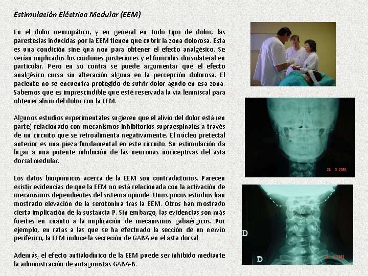 Estimulación Eléctrica Medular (EEM) En el dolor neuropático, y en general en todo tipo