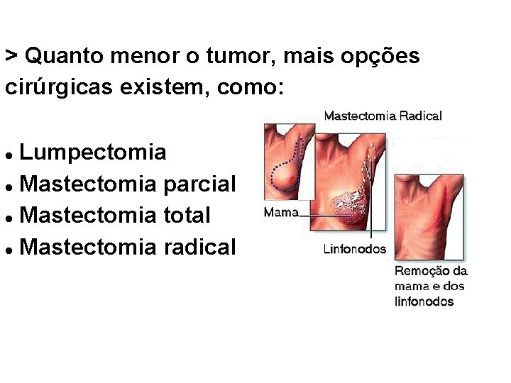 > Quanto menor o tumor, mais opções cirúrgicas existem, como: Lumpectomia Mastectomia parcial Mastectomia > Quanto menor o tumor, mais opções cirúrgicas existem, como: Lumpectomia Mastectomia parcial Mastectomia
