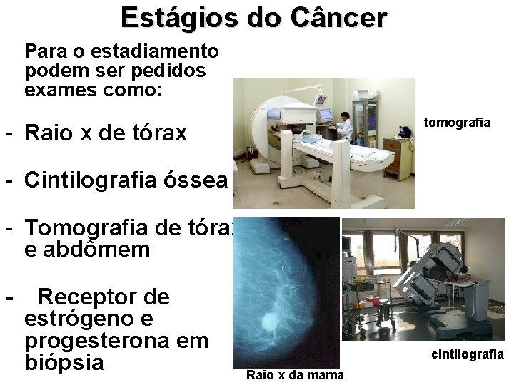 Estágios do Câncer Para o estadiamento podem ser pedidos exames como: tomografia - Raio Estágios do Câncer Para o estadiamento podem ser pedidos exames como: tomografia - Raio