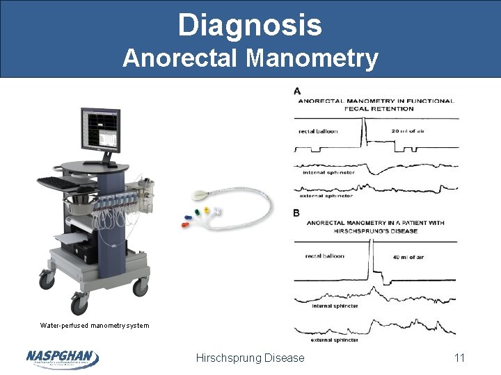 Diagnosis Anorectal Manometry Water-perfused manometry system Hirschsprung Disease 11 Diagnosis Anorectal Manometry Water-perfused manometry system Hirschsprung Disease 11