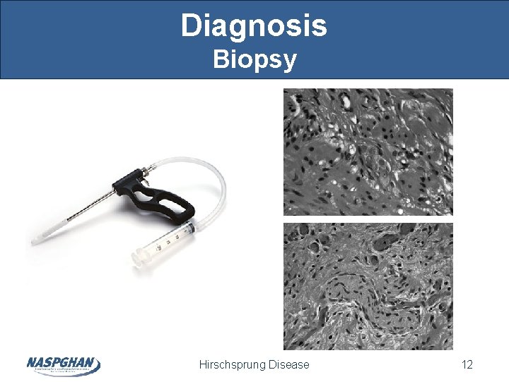 Diagnosis Biopsy Hirschsprung Disease 12 Diagnosis Biopsy Hirschsprung Disease 12