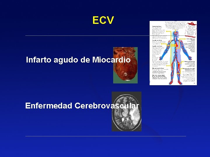 ECV Infarto agudo de Miocardio Enfermedad Cerebrovascular ECV Infarto agudo de Miocardio Enfermedad Cerebrovascular