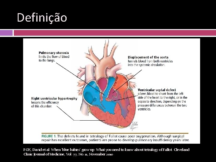 Definição FOX, David et al. When ‘blue babies’ grow up: What you need to