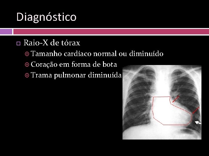 Diagnóstico Raio-X de tórax Tamanho cardíaco normal ou diminuído Coração em forma de bota