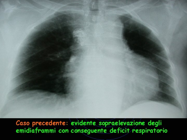 Caso precedente: evidente sopraelevazione degli emidiaframmi conseguente deficit respiratorio Caso precedente: evidente sopraelevazione degli emidiaframmi conseguente deficit respiratorio