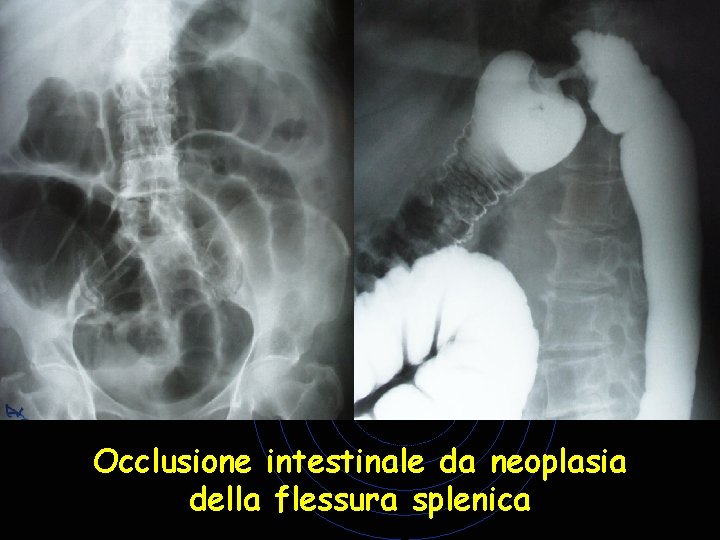 Occlusione intestinale da neoplasia della flessura splenica Occlusione intestinale da neoplasia della flessura splenica