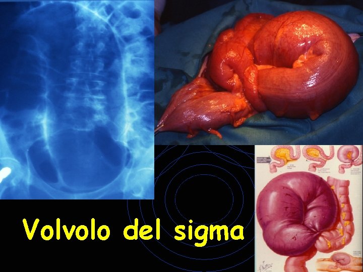 Volvolo del sigma Volvolo del sigma