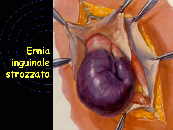Ernia inguinale strozzata Ernia inguinale strozzata