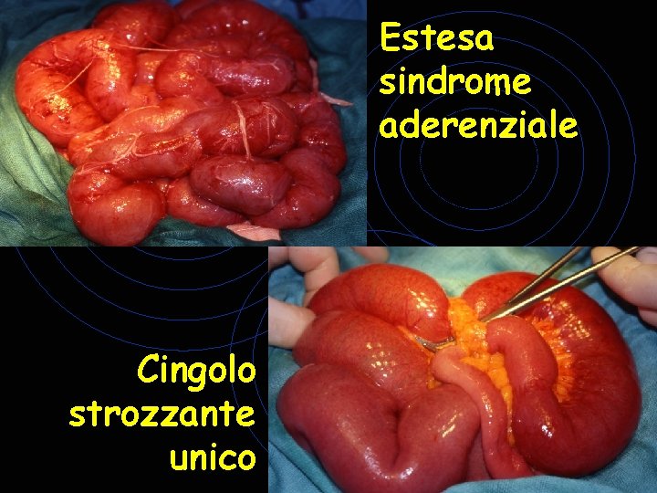 Estesa sindrome aderenziale Cingolo strozzante unico Estesa sindrome aderenziale Cingolo strozzante unico