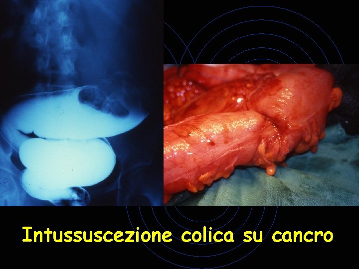 Intussuscezione colica su cancro Intussuscezione colica su cancro