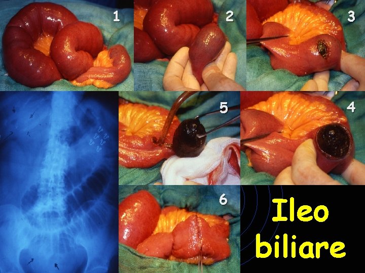 1 2 5 6 3 4 Ileo biliare 1 2 5 6 3 4 Ileo biliare