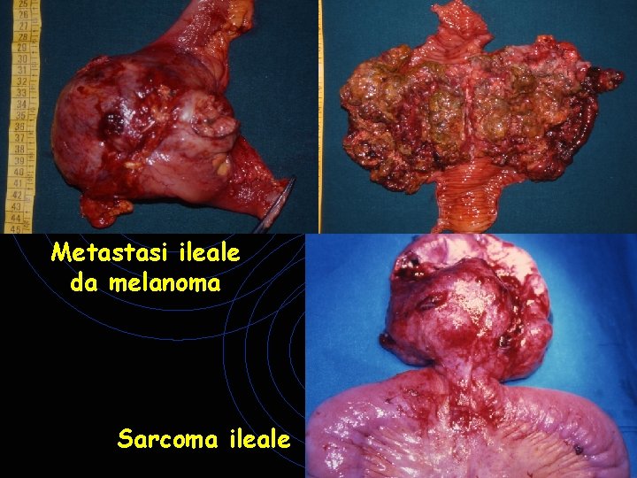 Metastasi ileale da melanoma Sarcoma ileale Metastasi ileale da melanoma Sarcoma ileale