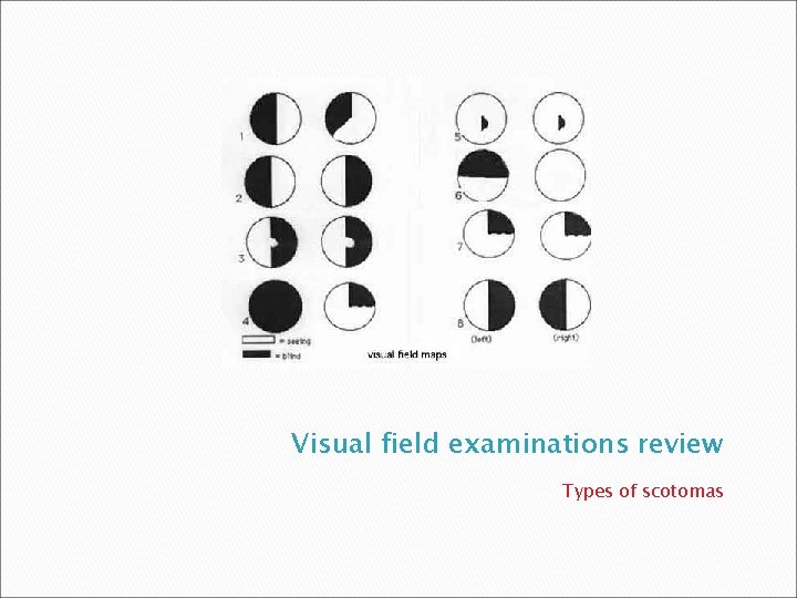 Visual field examinations review Types of scotomas 