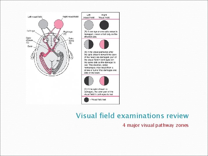Visual field examinations review 4 major visual pathway zones 