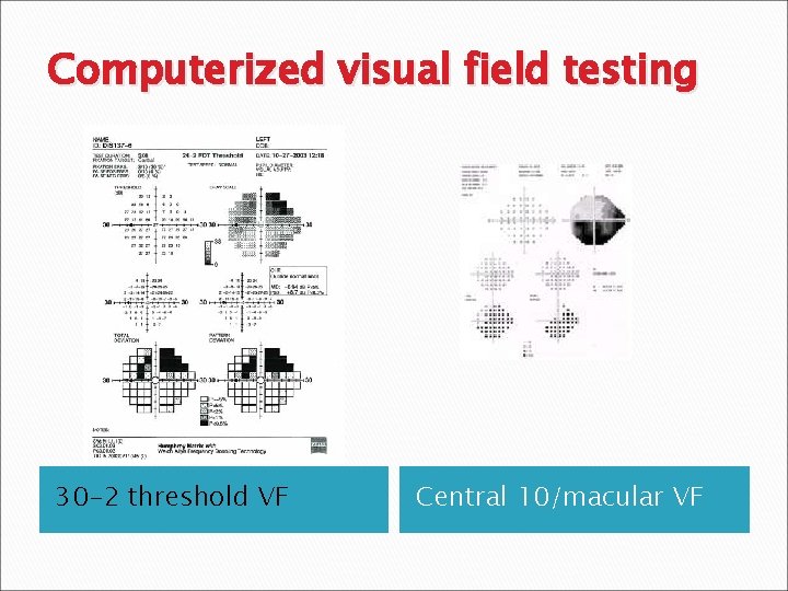 Computerized visual field testing 30 -2 threshold VF Central 10/macular VF 