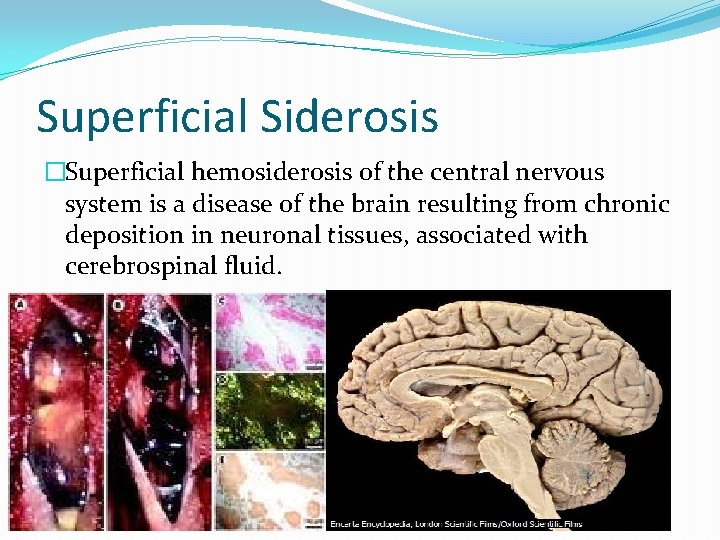 Superficial Siderosis �Superficial hemosiderosis of the central nervous system is a disease of the