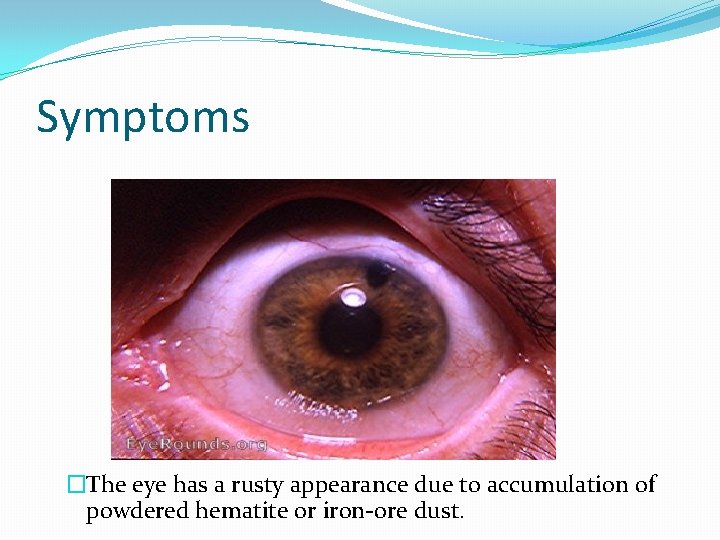 Symptoms �The eye has a rusty appearance due to accumulation of powdered hematite or
