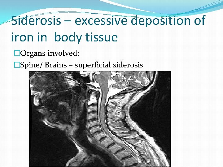 Siderosis – excessive deposition of iron in body tissue �Organs involved: �Spine/ Brains –