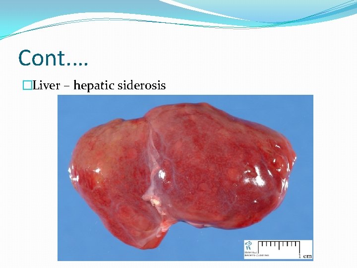 Cont. … �Liver – hepatic siderosis 