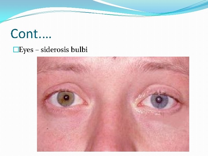 Cont. … �Eyes – siderosis bulbi 
