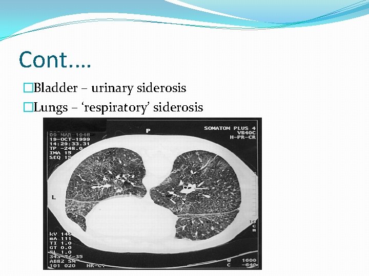 Cont. … �Bladder – urinary siderosis �Lungs – ‘respiratory’ siderosis 
