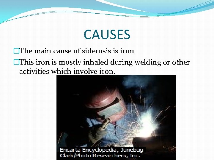 CAUSES �The main cause of siderosis is iron �This iron is mostly inhaled during