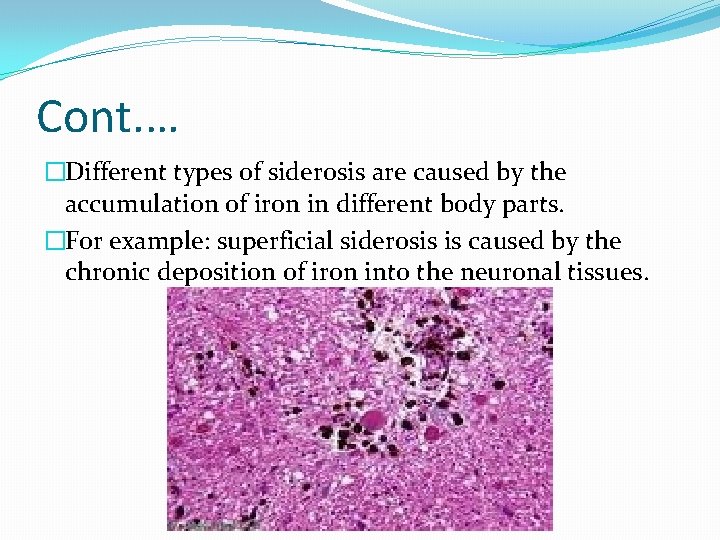 Cont. … �Different types of siderosis are caused by the accumulation of iron in