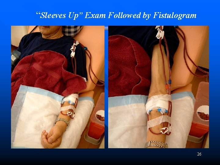 “Sleeves Up” Exam Followed by Fistulogram 26 