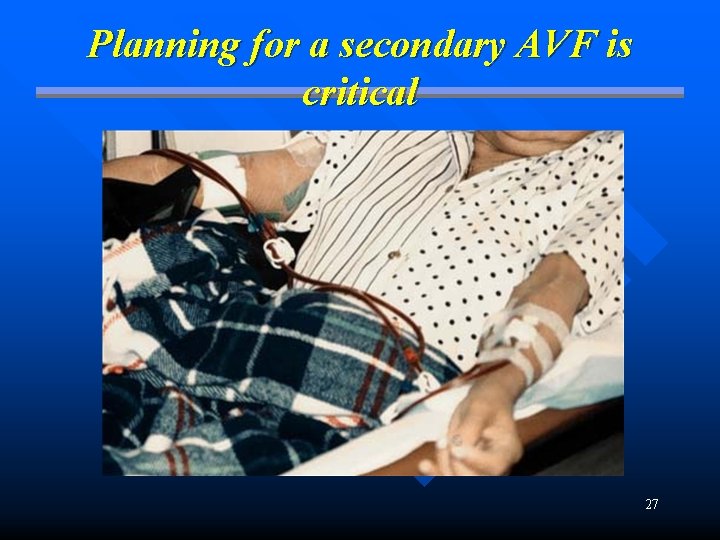 Planning for a secondary AVF is critical 27 