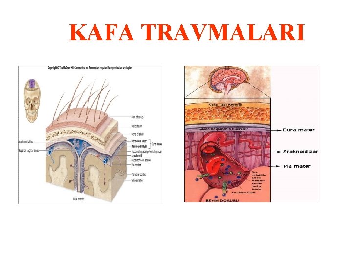 KAFA TRAVMALARI 