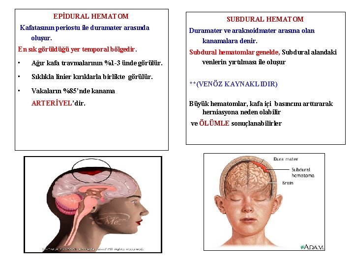 EPİDURAL HEMATOM SUBDURAL HEMATOM Kafatasının periostu ile duramater arasında oluşur. Duramater ve araknoidmater arasına