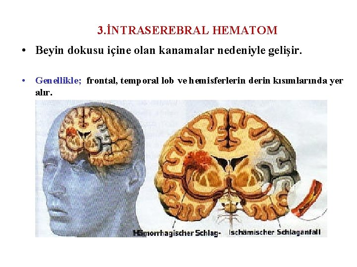 3. İNTRASEREBRAL HEMATOM • Beyin dokusu içine olan kanamalar nedeniyle gelişir. • Genellikle; frontal,