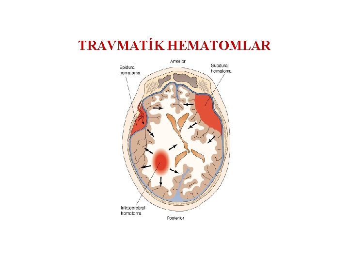 TRAVMATİK HEMATOMLAR 